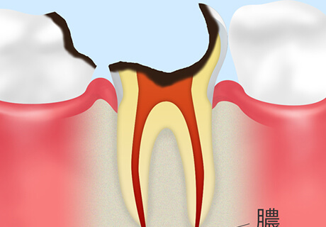 【C4】歯の大部分が溶けたむし歯